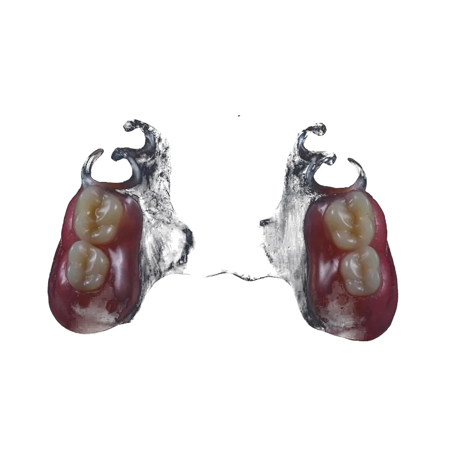 Acrylic partial denture with wire clasps on a working model