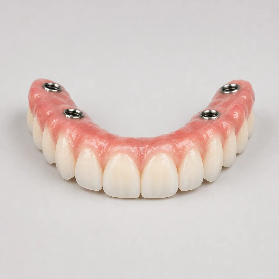 Full-arch implant-supported prosthesis with an acrylic base and denture teeth