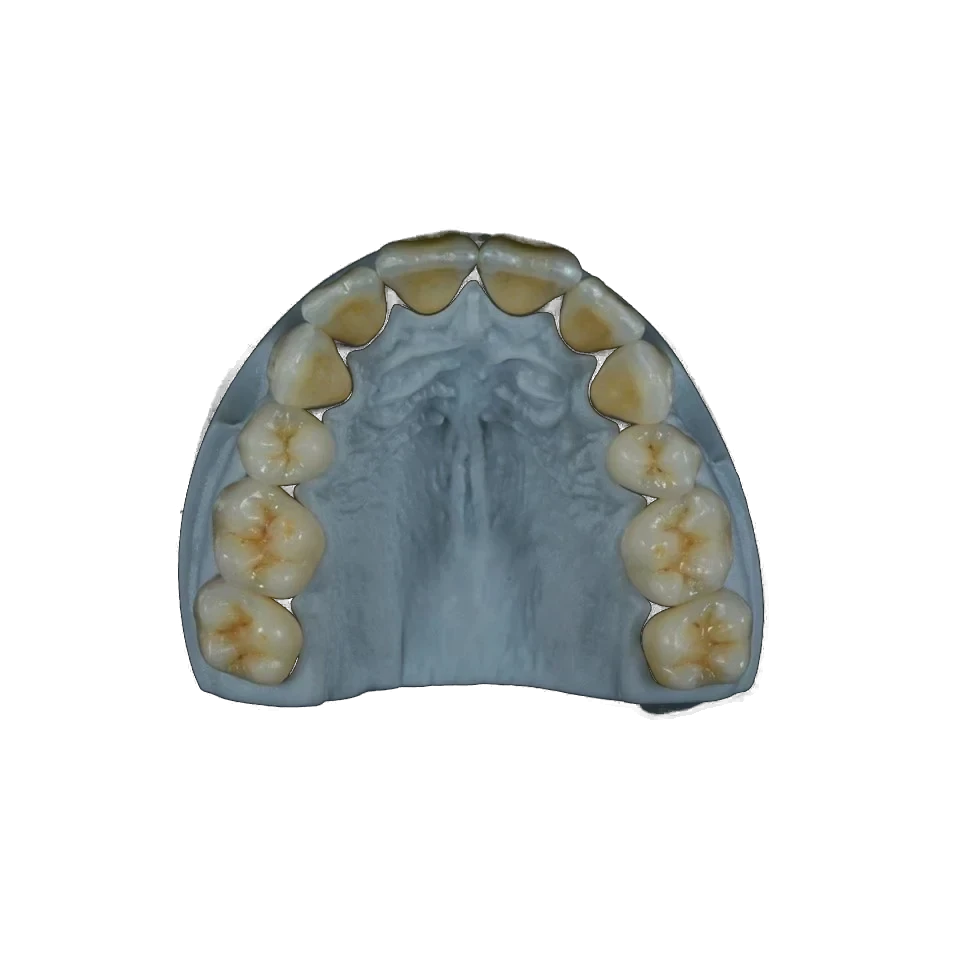 Porcelain-fused-to-zirconia crown with a layered ceramic surface on a working model